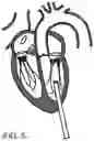 Fig. 04 - Fluid diversion devices for hydraulic delivery systems and associated methods