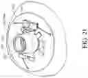 Fig. 28 - Prosthetic mitral valve holders