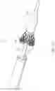 Fig. 26 - Delivery system for aided replacement valve recapture and repositioning post-deployment