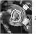 Fig. 16 - Valve translocation device and method for the treatment of functional valve regurgitation