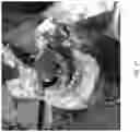 Fig. 19 - Valve translocation device and method for the treatment of functional valve regurgitation