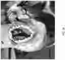 Fig. 20 - Valve translocation device and method for the treatment of functional valve regurgitation