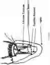 Fig. 29 - Valve translocation device and method for the treatment of functional valve regurgitation