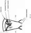 Fig. 30 - Valve translocation device and method for the treatment of functional valve regurgitation