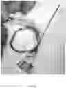 Fig. 35 - Valve translocation device and method for the treatment of functional valve regurgitation