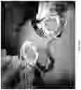 Fig. 41 - Valve translocation device and method for the treatment of functional valve regurgitation