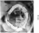 Fig. 45 - Valve translocation device and method for the treatment of functional valve regurgitation