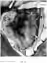 Fig. 47 - Valve translocation device and method for the treatment of functional valve regurgitation