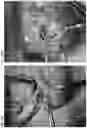 Fig. 49 - Valve translocation device and method for the treatment of functional valve regurgitation