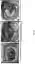 Fig. 50 - Valve translocation device and method for the treatment of functional valve regurgitation