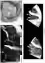Fig. 51 - Valve translocation device and method for the treatment of functional valve regurgitation