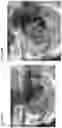 Fig. 55 - Valve translocation device and method for the treatment of functional valve regurgitation