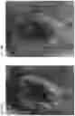 Fig. 57 - Valve translocation device and method for the treatment of functional valve regurgitation