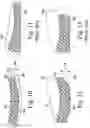 Fig. 07 - ORTHOPAEDIC IMPLANT SYSTEM WITH BONE CONSERVING FEATURES