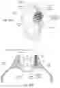 Fig. 22 - Apparatus, systems, and methods for the fixation or fusion of bone