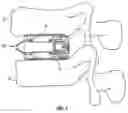 Fig. 02 - Expandable fusion device and method of installation thereof