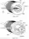 Fig. 49 - Delivery system and method for self-centering a proximal end of a stent graft