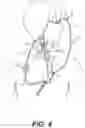 Fig. 06 - Systems and methods for treating eye diseases