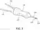 Fig. 04 - Vitrector and method for performing a one-step posterior vitrectomy using the same