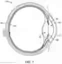 Fig. 02 - Intraocular implant device method