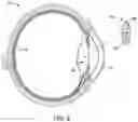 Fig. 03 - Intraocular implant device method