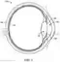 Fig. 02 - Artificial vision intraocular implant device
