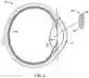 Fig. 03 - Artificial vision intraocular implant device