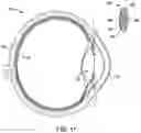 Fig. 13 - Artificial vision intraocular implant device