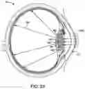 Fig. 25 - Artificial vision intraocular implant device