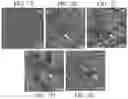 Fig. 06 - Method for treating neoplasms using hollow silica spheres