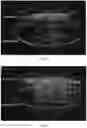 Fig. 05 - Surface-modified mesoporous silica nanoparticle for blood-brain barrier penetration,tumor targeting and cancer metastasis treatment, methods of production and uses thereof