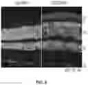 Fig. 07 - Methods and compositions for treating cone-rod retinal dystrophy