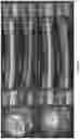 Fig. 08 - Methods and compositions for treating cone-rod retinal dystrophy