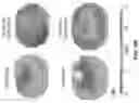 Fig. 09 - Methods and compositions for treating cone-rod retinal dystrophy