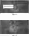 Fig. 12 - PRESSURE INFUSION DEVICE FOR RETAINING INFUSION BAG AND ADJUSTABLE GRAVITY-INDEPENDENT OPERATION THEREOF