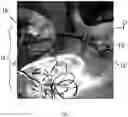 Fig. 02 - Surgical Insufflation Systems and Methods for Use
