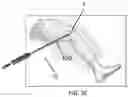Fig. 08 - Surgical Insufflation Systems and Methods for Use