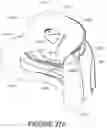 Fig. 137 - Oro-nasal patient interface