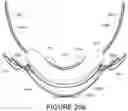 Fig. 147 - Oro-nasal patient interface