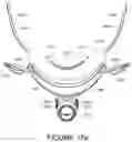 Fig. 78 - Oro-nasal patient interface