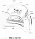 Fig. 84 - Oro-nasal patient interface