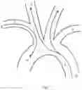 Fig. 02 - Transradial Access Systems Particularly Useful for Cerebral Access