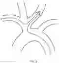 Fig. 03 - Transradial Access Systems Particularly Useful for Cerebral Access