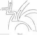 Fig. 04 - Transradial Access Systems Particularly Useful for Cerebral Access