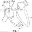 Fig. 02 - Biostimulator transport system having valve bypass tool