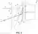 Fig. 03 - Systems and methods for locating an inserted catheter tip
