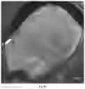 Fig. 10 - Microneedle for local delivery of therapeutic agent