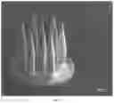 Fig. 14 - Microneedle for local delivery of therapeutic agent