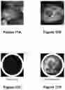 Fig. 16 - Systems and methods for visualizing ablated tissue