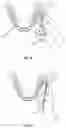 Fig. 07 - DEVICE AND METHOD FOR INTRAOSSEOUS DENTAL ANESTHETIZATION